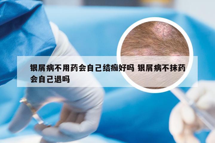 银屑病不用药会自己结痂好吗 银屑病不抹药会自己退吗