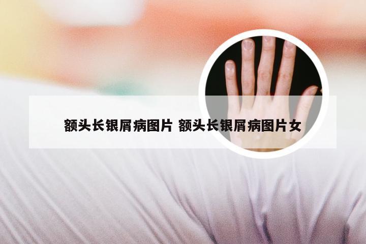 额头长银屑病图片 额头长银屑病图片女