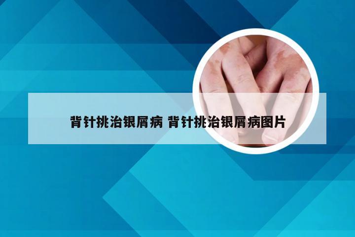 背针挑治银屑病 背针挑治银屑病图片
