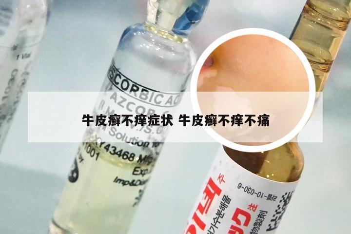 牛皮癣不痒症状 牛皮癣不痒不痛