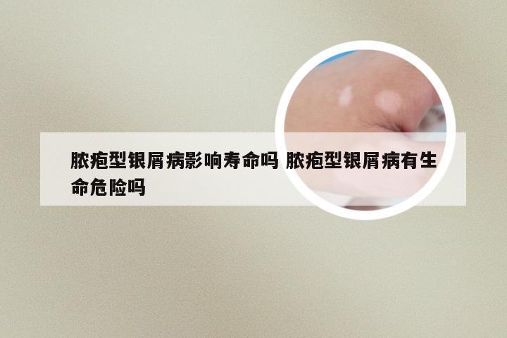 脓疱型银屑病影响寿命吗 脓疱型银屑病有生命危险吗