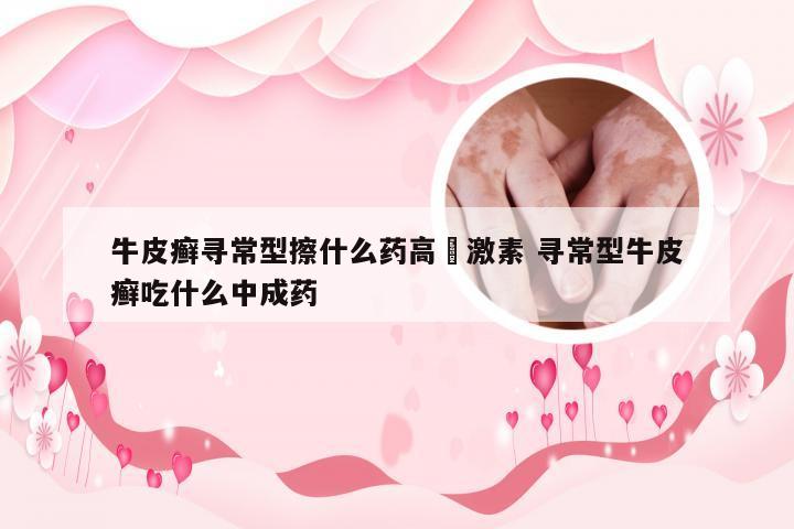 牛皮癣寻常型擦什么药高旡激素 寻常型牛皮癣吃什么中成药