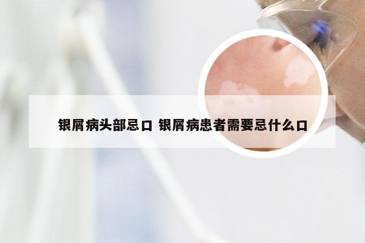 银屑病头部忌口 银屑病患者需要忌什么口