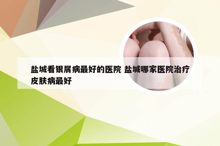 盐城看银屑病最好的医院 盐城哪家医院治疗皮肤病最好