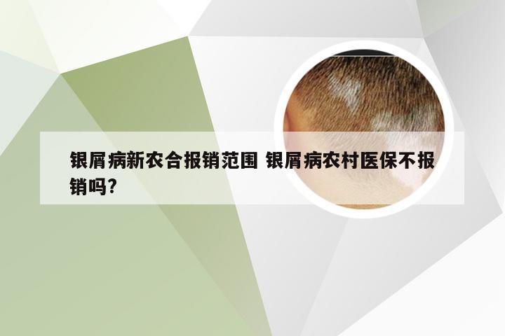 银屑病新农合报销范围 银屑病农村医保不报销吗?
