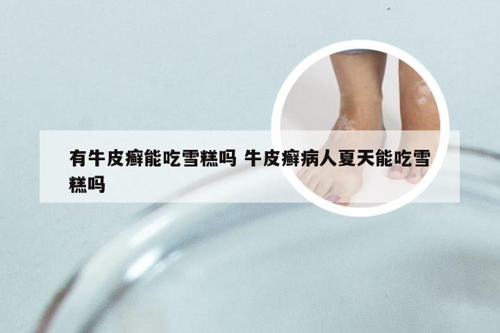 有牛皮癣能吃雪糕吗 牛皮癣病人夏天能吃雪糕吗