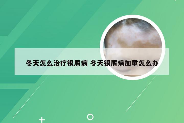 冬天怎么治疗银屑病 冬天银屑病加重怎么办