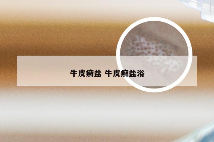 牛皮癣盐 牛皮癣盐浴