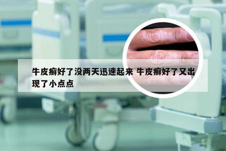 牛皮癣好了没两天迅速起来 牛皮癣好了又出现了小点点