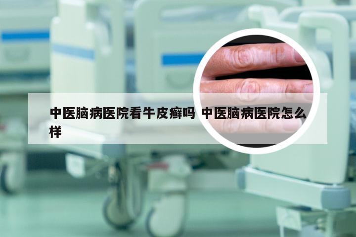 中医脑病医院看牛皮癣吗 中医脑病医院怎么样
