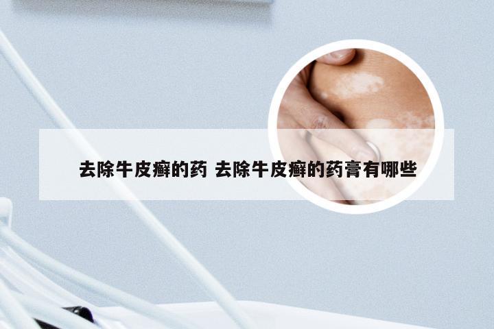 去除牛皮癣的药 去除牛皮癣的药膏有哪些