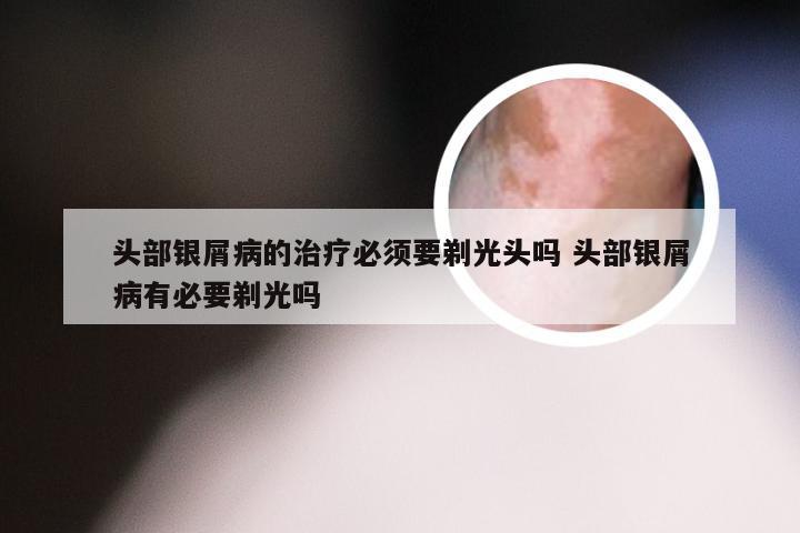 头部银屑病的治疗必须要剃光头吗 头部银屑病有必要剃光吗