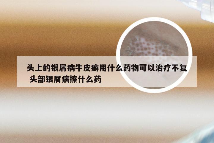 头上的银屑病牛皮癣用什么药物可以治疗不复 头部银屑病擦什么药