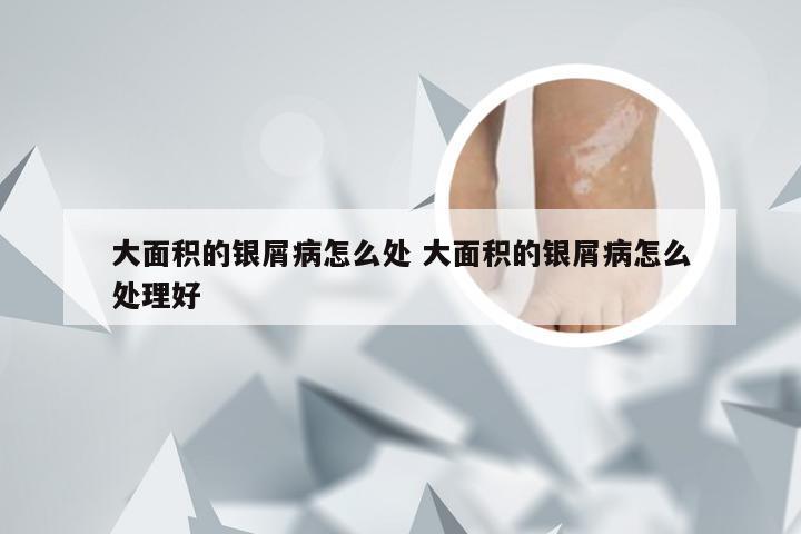 大面积的银屑病怎么处 大面积的银屑病怎么处理好