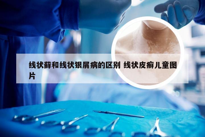 线状藓和线状银屑病的区别 线状皮癣儿童图片