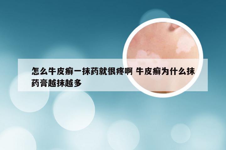 怎么牛皮癣一抹药就很疼啊 牛皮癣为什么抹药膏越抹越多