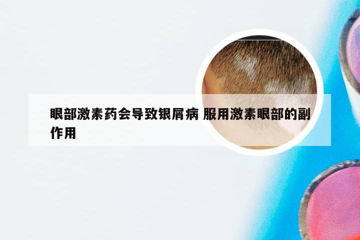 眼部激素药会导致银屑病 服用激素眼部的副作用