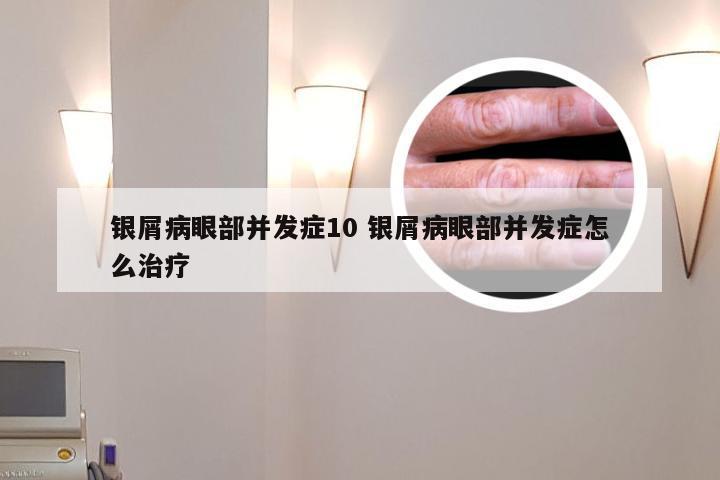 银屑病眼部并发症10 银屑病眼部并发症怎么治疗