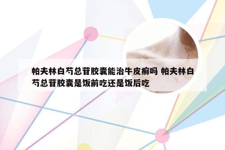 帕夫林白芍总苷胶囊能治牛皮癣吗 帕夫林白芍总苷胶囊是饭前吃还是饭后吃