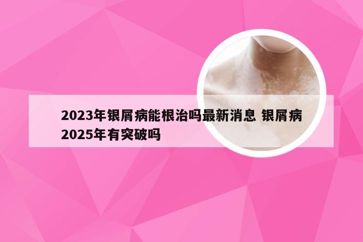 2023年银屑病能根治吗最新消息 银屑病2025年有突破吗