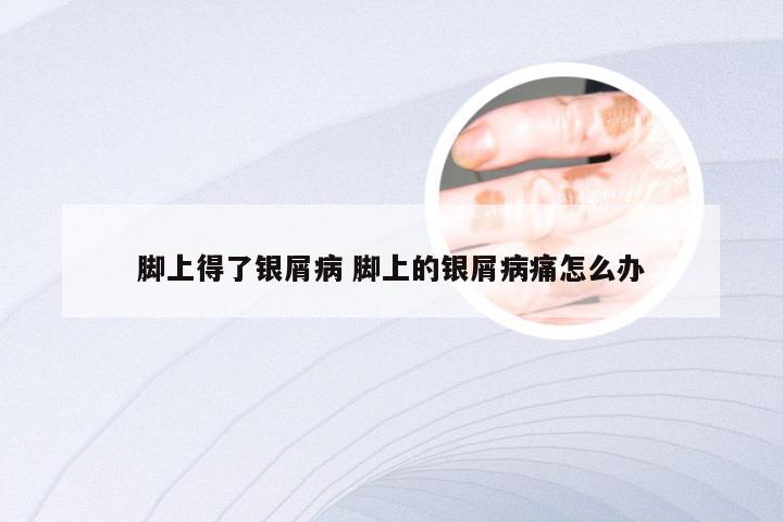 脚上得了银屑病 脚上的银屑病痛怎么办