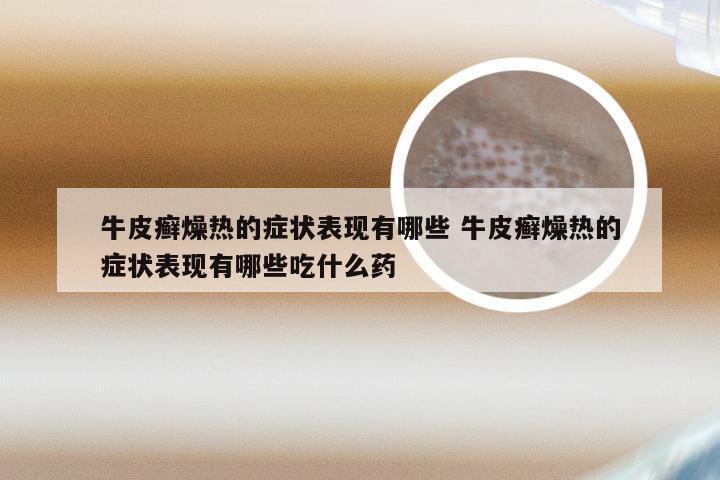 牛皮癣燥热的症状表现有哪些 牛皮癣燥热的症状表现有哪些吃什么药