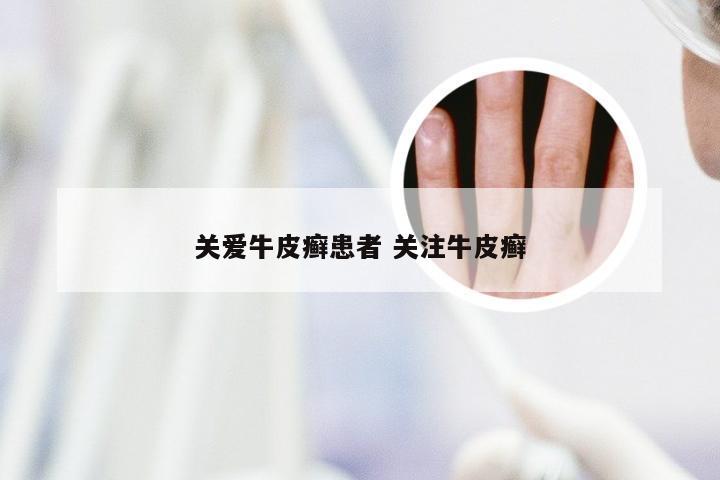 关爱牛皮癣患者 关注牛皮癣