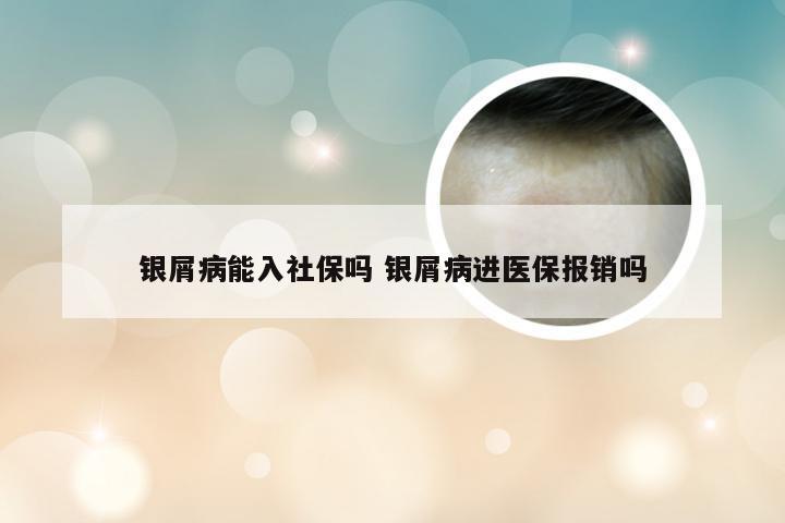 银屑病能入社保吗 银屑病进医保报销吗