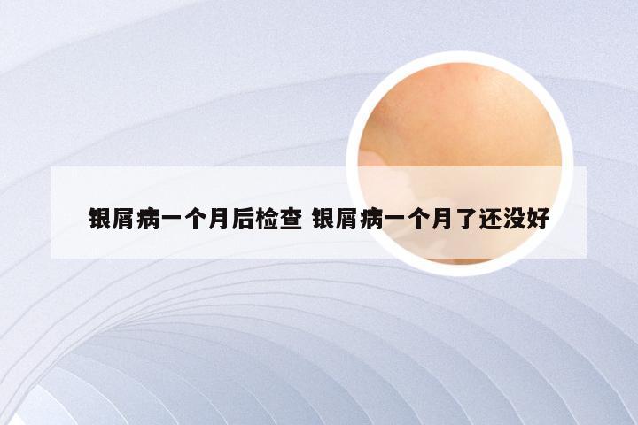 银屑病一个月后检查 银屑病一个月了还没好