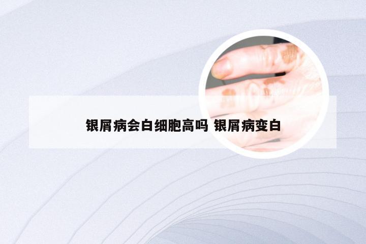 银屑病会白细胞高吗 银屑病变白