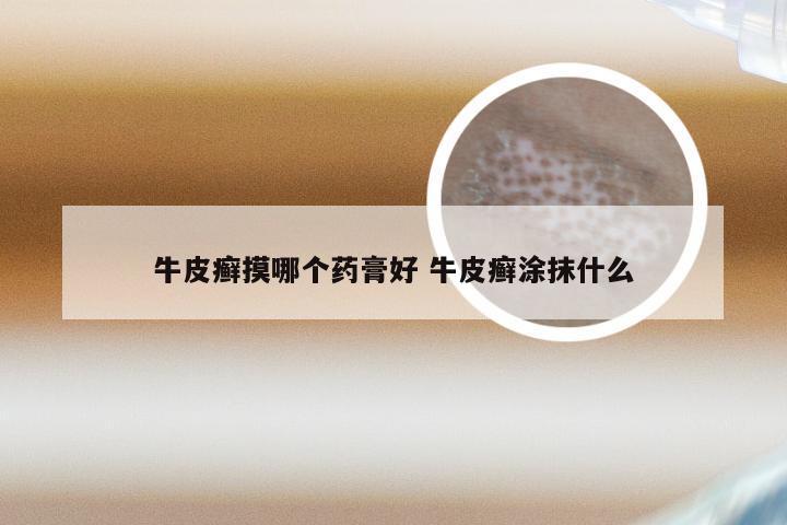 牛皮癣摸哪个药膏好 牛皮癣涂抹什么