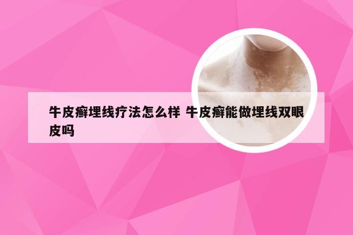 牛皮癣埋线疗法怎么样 牛皮癣能做埋线双眼皮吗