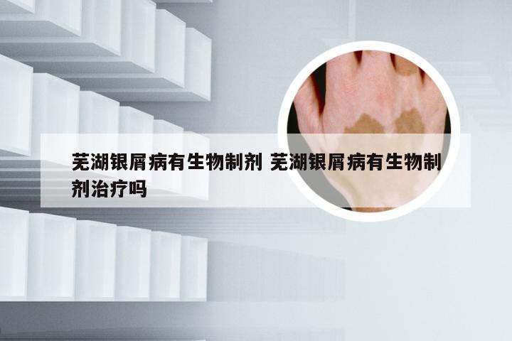 芜湖银屑病有生物制剂 芜湖银屑病有生物制剂治疗吗