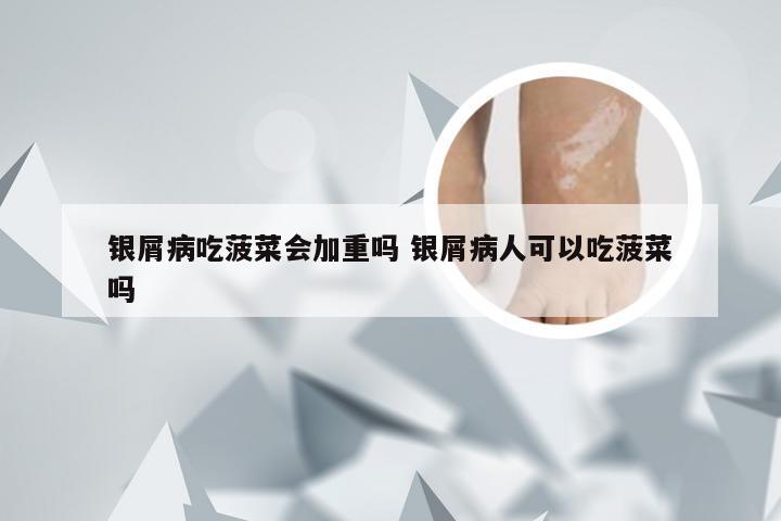 银屑病吃菠菜会加重吗 银屑病人可以吃菠菜吗
