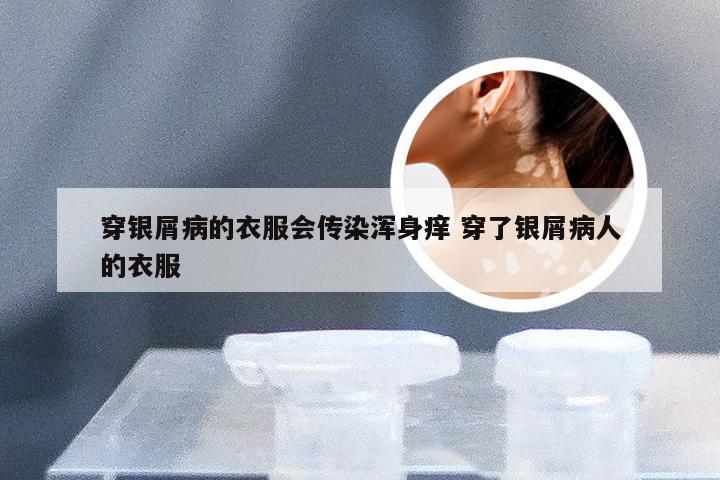 穿银屑病的衣服会传染浑身痒 穿了银屑病人的衣服
