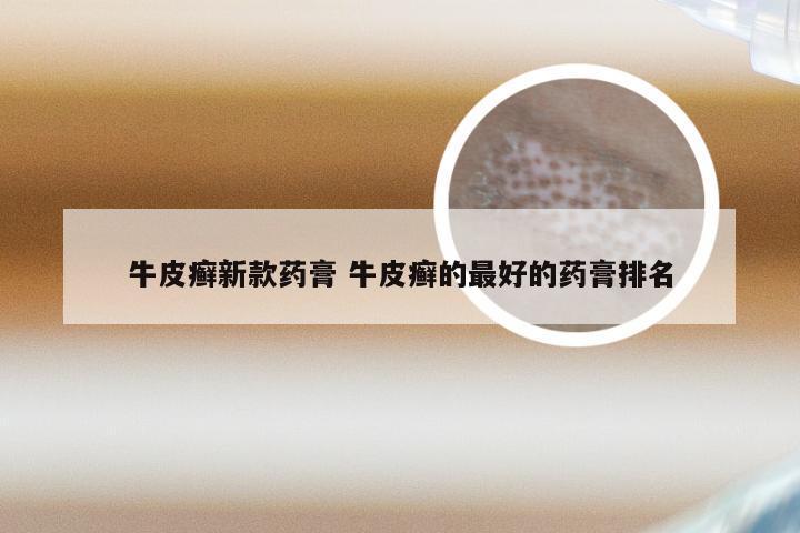 牛皮癣新款药膏 牛皮癣的最好的药膏排名