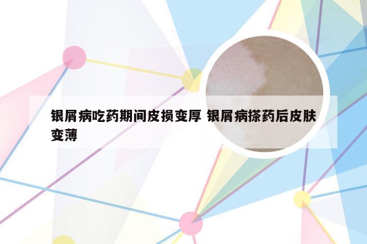银屑病吃药期间皮损变厚 银屑病搽药后皮肤变薄