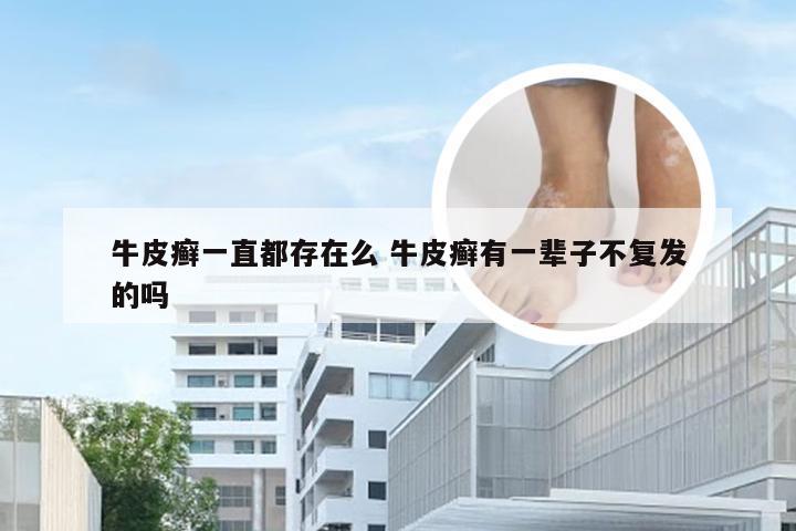 牛皮癣一直都存在么 牛皮癣有一辈子不复发的吗