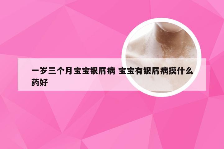 一岁三个月宝宝银屑病 宝宝有银屑病摸什么药好