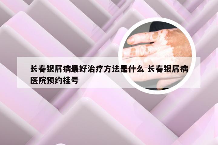 长春银屑病最好治疗方法是什么 长春银屑病医院预约挂号