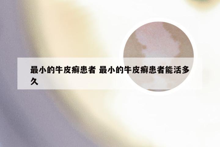 最小的牛皮癣患者 最小的牛皮癣患者能活多久