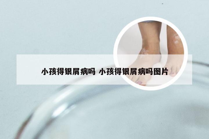 小孩得银屑病吗 小孩得银屑病吗图片