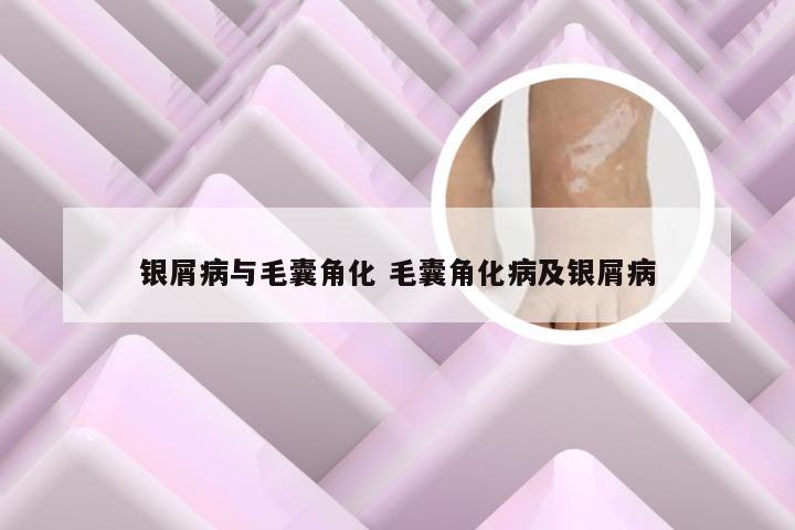 银屑病与毛囊角化 毛囊角化病及银屑病