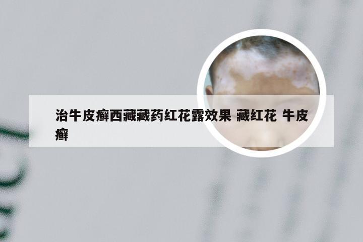 治牛皮癣西藏藏药红花露效果 藏红花 牛皮癣