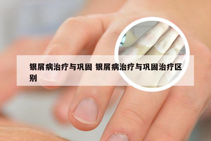 银屑病治疗与巩固 银屑病治疗与巩固治疗区别