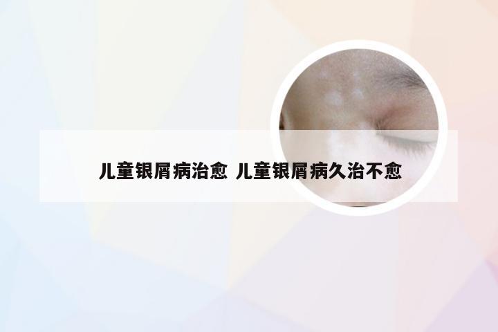 儿童银屑病治愈 儿童银屑病久治不愈