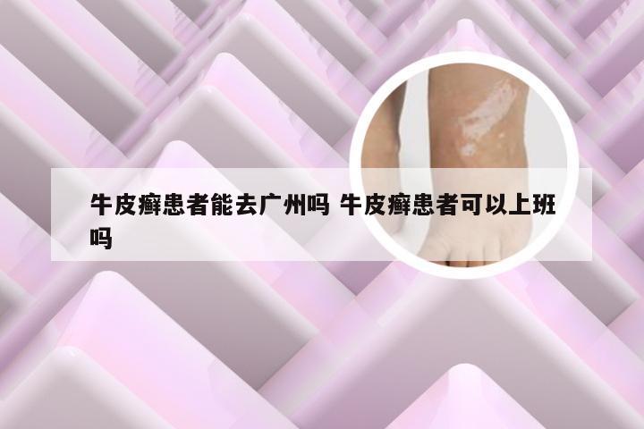 牛皮癣患者能去广州吗 牛皮癣患者可以上班吗