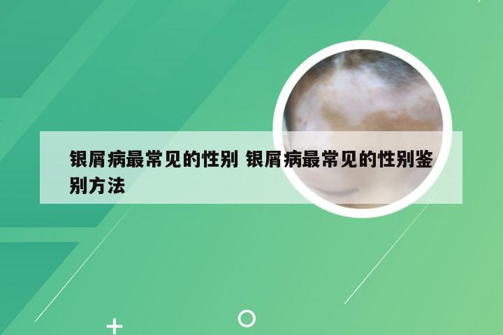 银屑病最常见的性别 银屑病最常见的性别鉴别方法