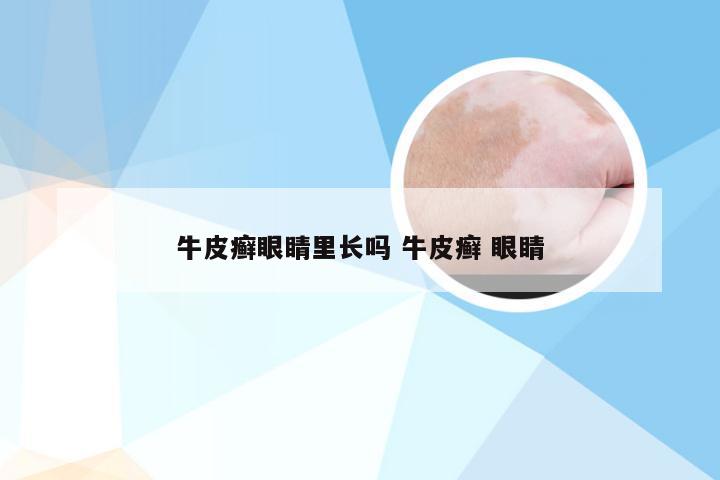 牛皮癣眼睛里长吗 牛皮癣 眼睛