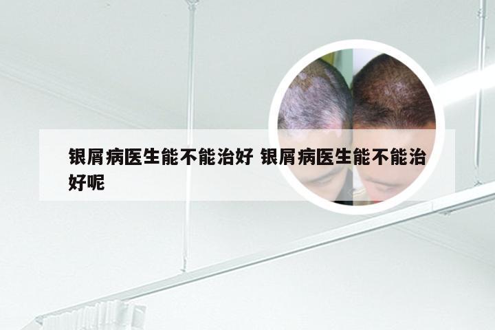 银屑病医生能不能治好 银屑病医生能不能治好呢
